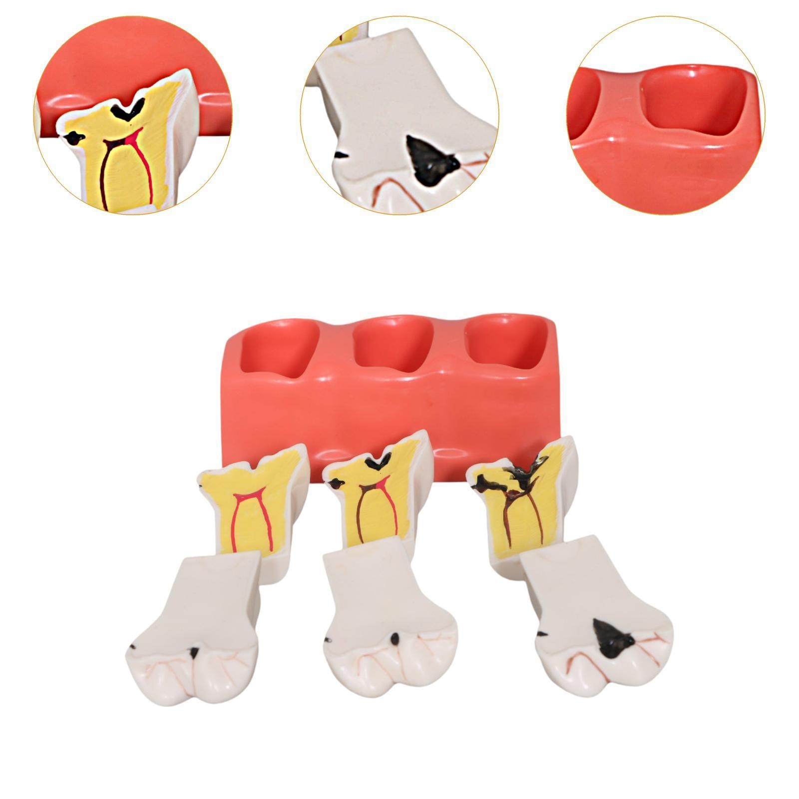 Sumulation Decay Tooth Model Educational Materials Removable Biology