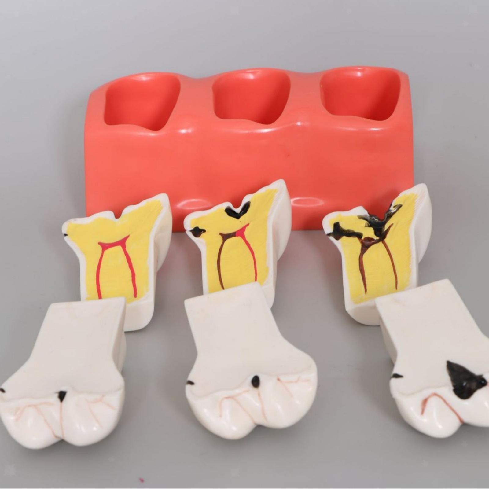 Sumulation Decay Tooth Model Educational Materials Removable Biology
