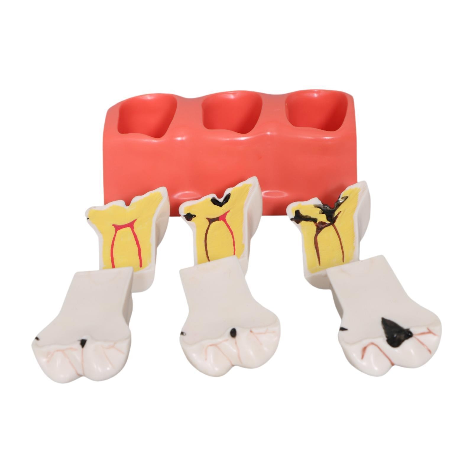 Sumulation Decay Tooth Model Educational Materials Removable Biology