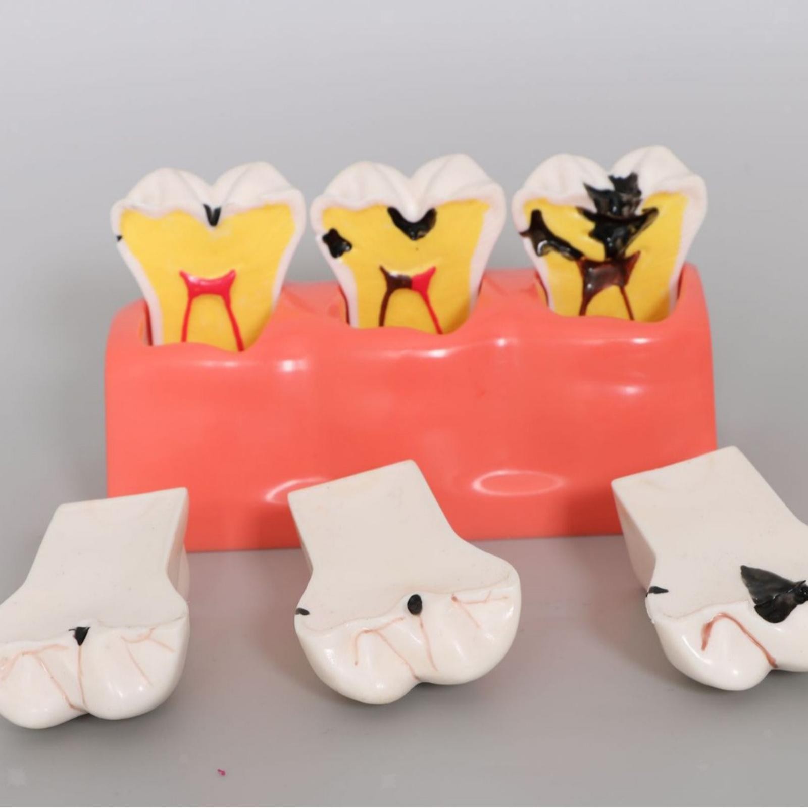 Sumulation Decay Tooth Model Educational Materials Removable Biology