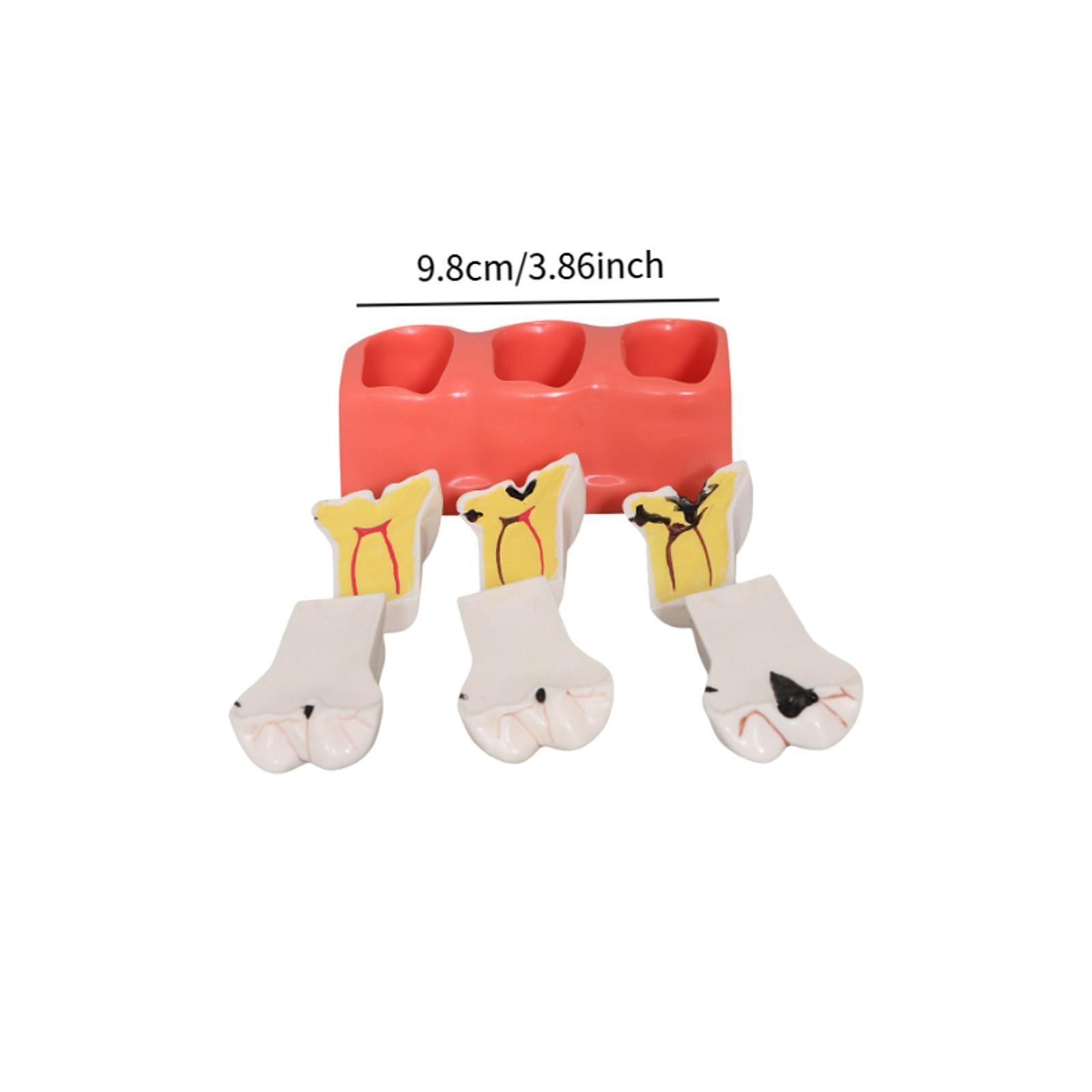 Sumulation Decay Tooth Model Educational Materials Removable Biology