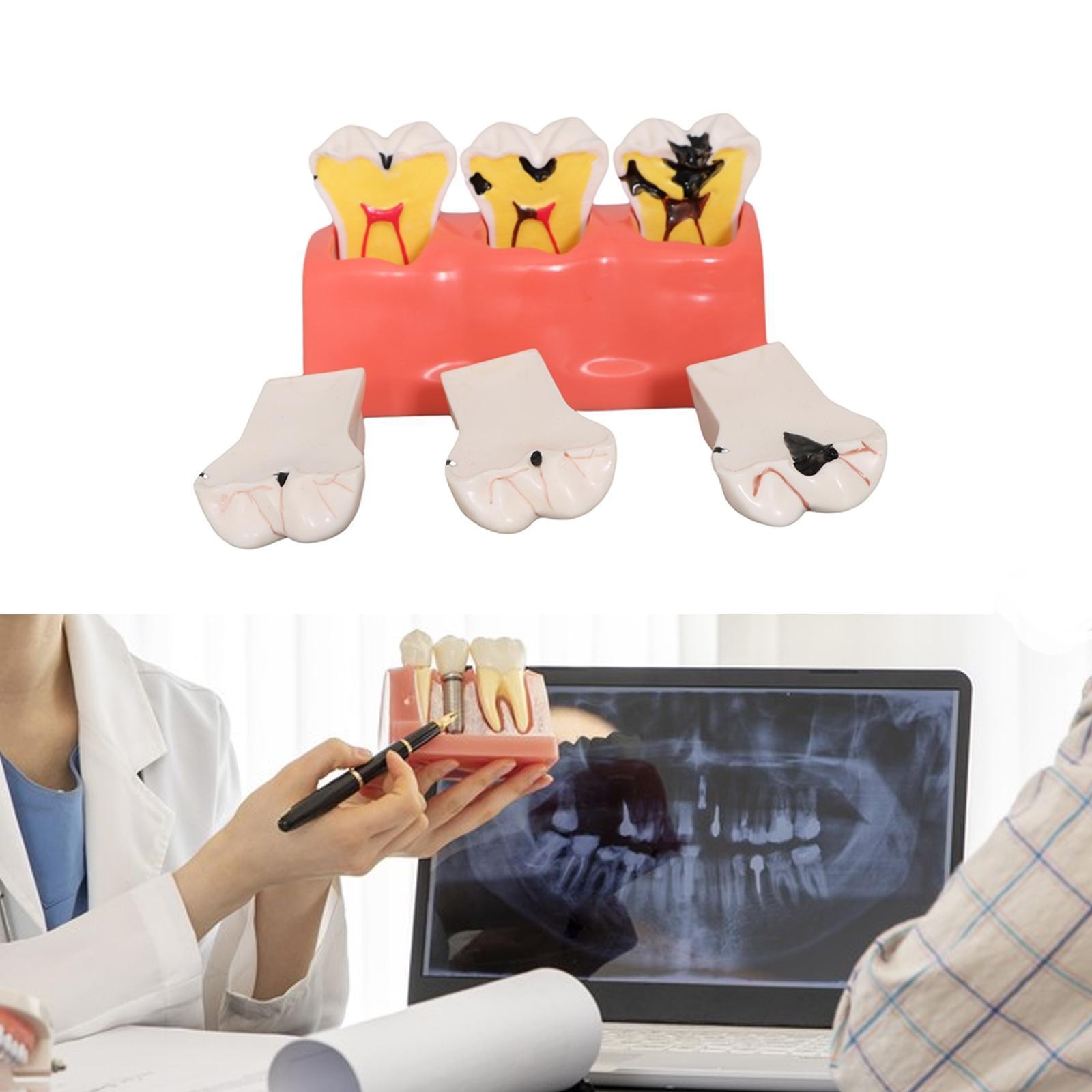Sumulation Decay Tooth Model Educational Materials Removable Biology